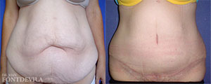 Abdominoplastia