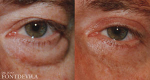 Blefaroplastia