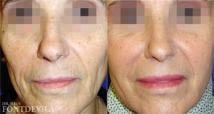 Lipoinyección Facial