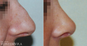 Rinoplastia